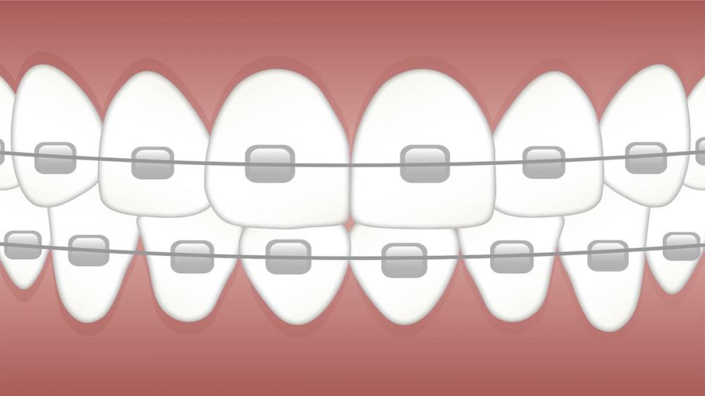 Ketahui Berbagai Manfaat Pasang Kawat Gigi di Dokter Gigi Jogja!