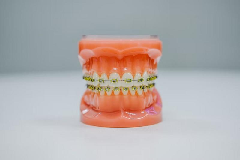 Penyebab Kenapa Anda Harus Memasang Kawat Gigi Jogja