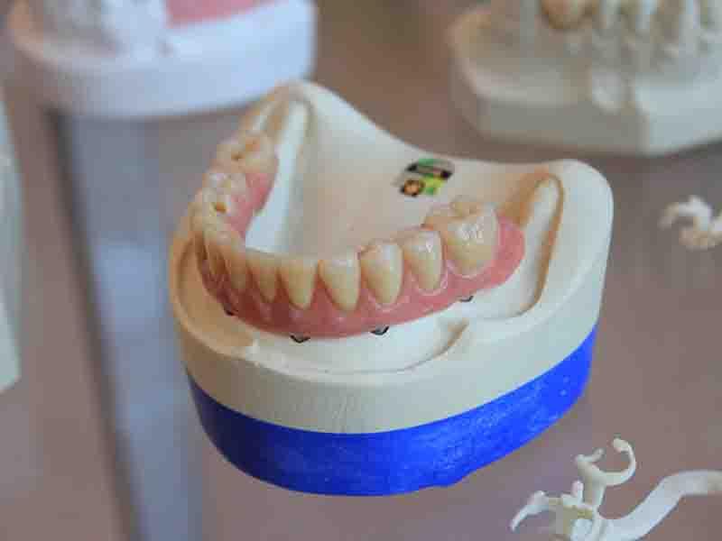 Waktu Terbaik Pemasangan Gigi Palsu Jogja Setelah Dicabut